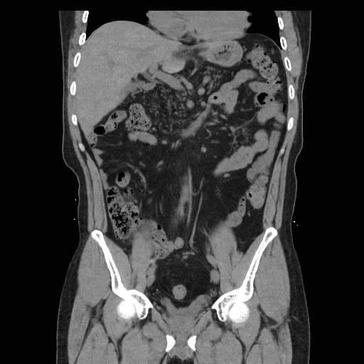 File:Colocutaneous fistula in Crohn's disease (Radiopaedia 29586-30093 Coronal non-contrast 13).jpg