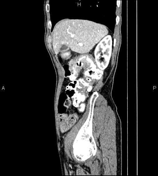Colon adenocarcinoma - hepatic flexure (Radiopaedia 85635-101395 D 19).jpg