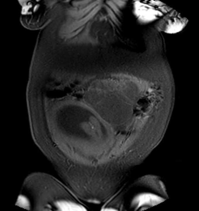 Colon adenocarcinoma with Krukenberg tumors, advanced pregnancy (Radiopaedia 67279-76645 E 10).jpg