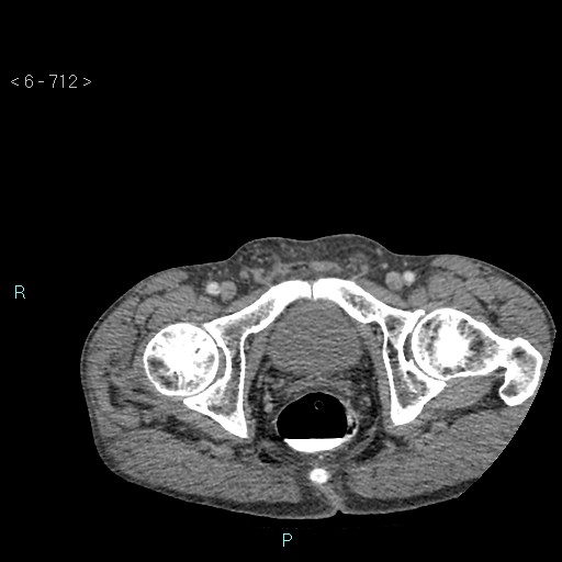 File:Colonic cancer (ultrasound and TC imaging) (Radiopaedia 50346-55713 A 144).jpg