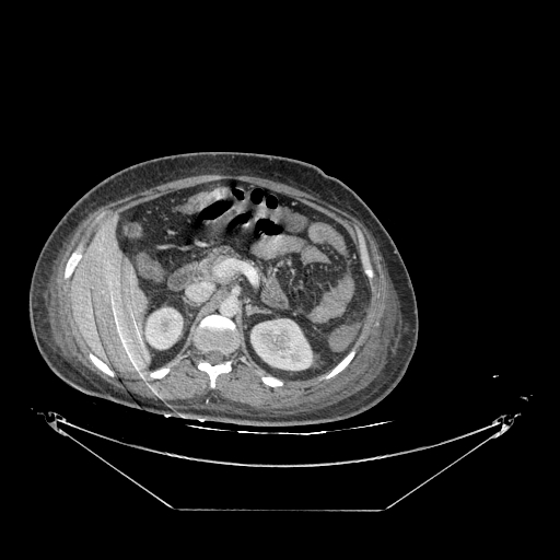 Colonic infarction after colostomy creation (Radiopaedia 81157-94797 A 40).jpg