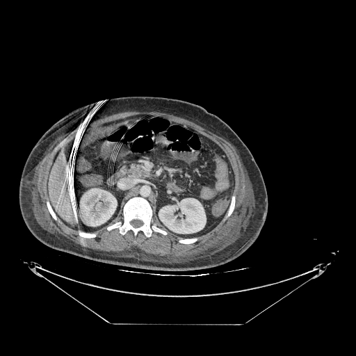 Colonic infarction after colostomy creation (Radiopaedia 81157-94797 A 54).jpg