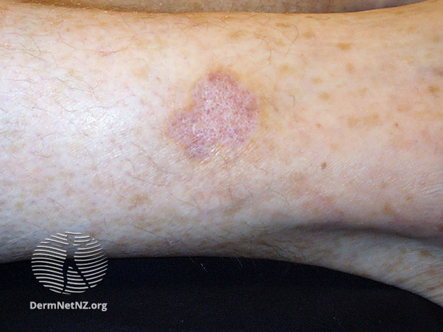 File:Curettage scar (DermNet NZ vascular-atrophie1).jpg