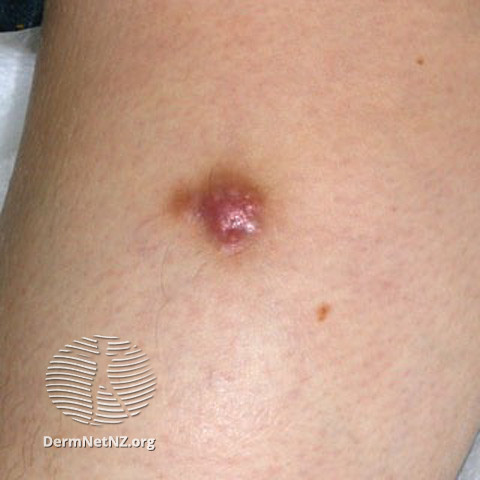 File:Dermatofibroma (DermNet NZ lesions-s-df6).jpg