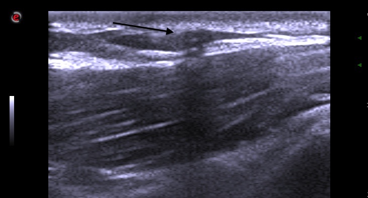 File:Distal catheter of VP shunt detected by breast ultrasound (Radiopaedia 51009).jpg