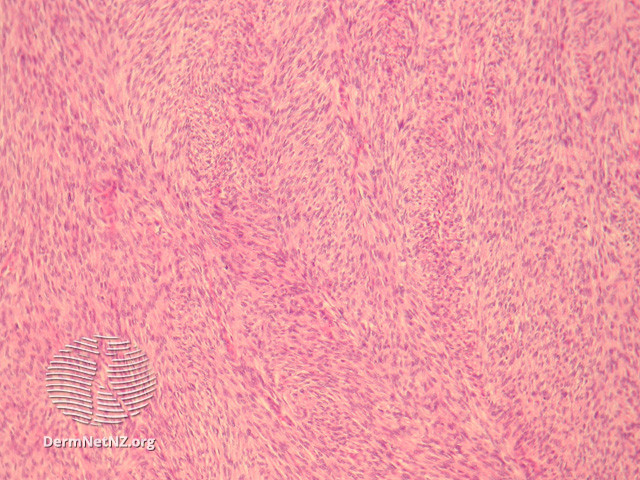 File:Figure 3 (DermNet NZ pathology-e-fibrosarcoma-figure-3).jpg