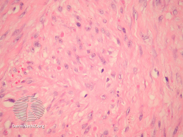 File:Figure 3 (DermNet NZ pathology-e-infantile-digital-fibromatosis-figure-3).jpg