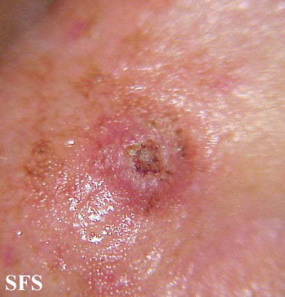 File:Keratoacanthoma (Dermatology Atlas 13).jpg