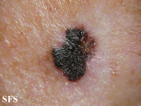 File:Melanoma (Dermatology Atlas 12).jpg