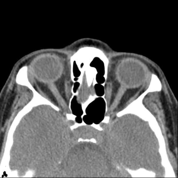 Nasolabial cyst (Radiopaedia 33987-35205 Axial non-contrast 37).jpg