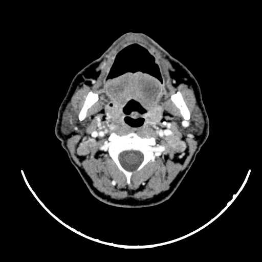 File:Nasopharyngeal carcinoma - infiltrating the clivus (Radiopaedia 62583-70875 Axial Post contrast 28).jpg