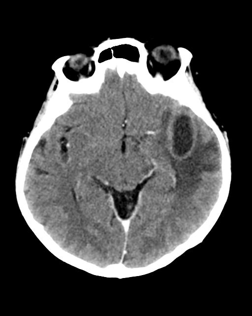 Nasopharyngeal carcinoma with cerebral abscess (Radiopaedia 43018-46275 Axial C+ delayed 23).png