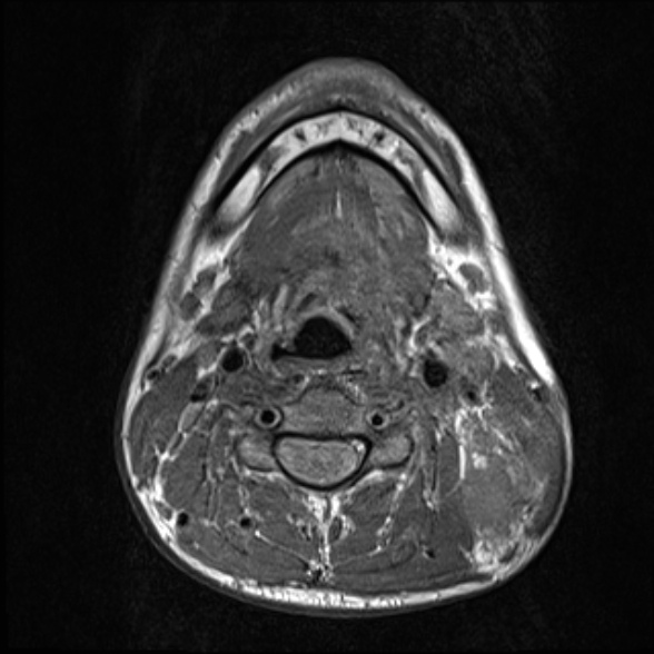 File:Nasopharyngeal carcinoma with skull base invasion (Radiopaedia 53415-59485 Axial T1 50).jpg
