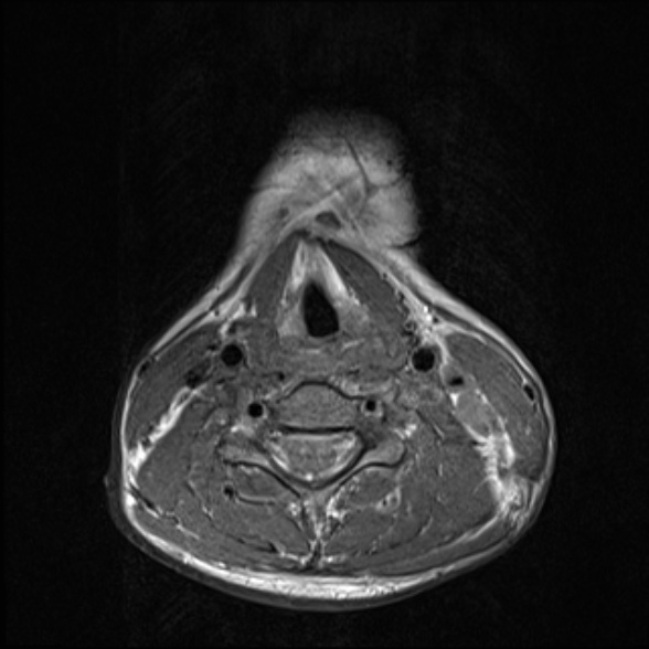 Nasopharyngeal carcinoma with skull base invasion (Radiopaedia 53415-59485 Axial T1 56).jpg