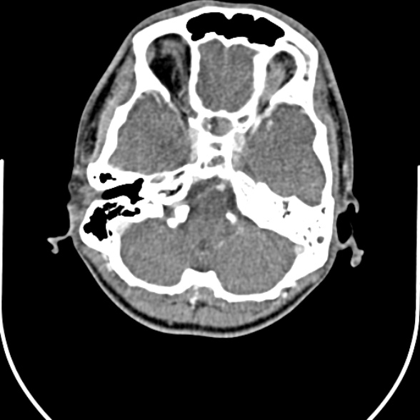 File:Nasopharyngeal carcinoma with skull base invasion (Radiopaedia 53415-59705 A 11).jpg