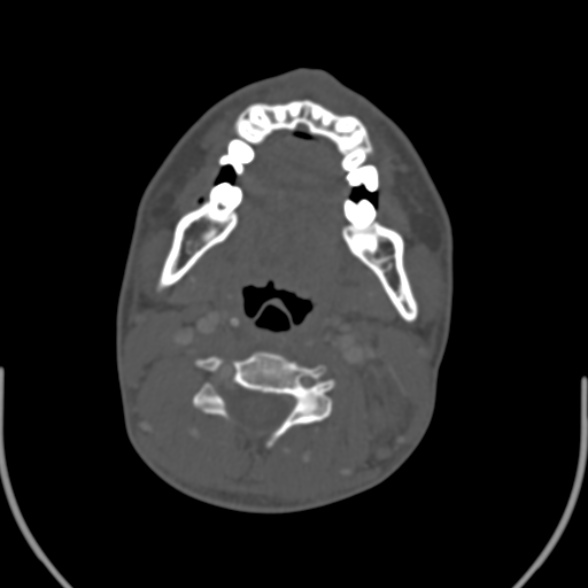 Nasopharyngeal carcinoma with skull base invasion (Radiopaedia 53415-59705 Axial bone window 106).jpg