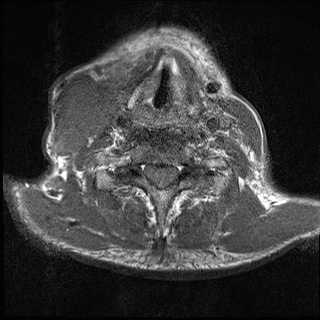 File:Nasopharyngeal carcinoma with skull base invasion (Radiopaedia 59258-66600 Axial T1 11).jpg