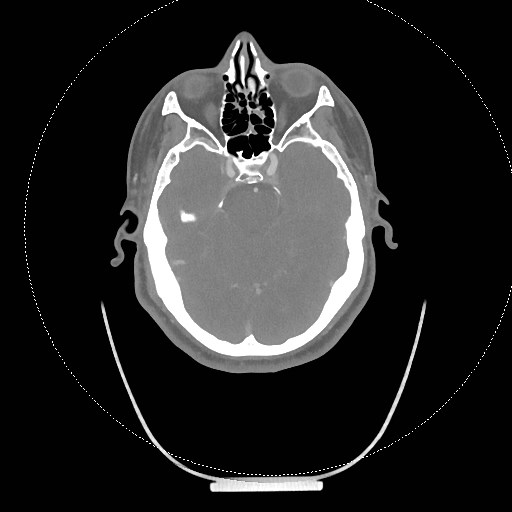 Neck CT angiogram (intraosseous vascular access) (Radiopaedia 55481-61945 B 285).jpg