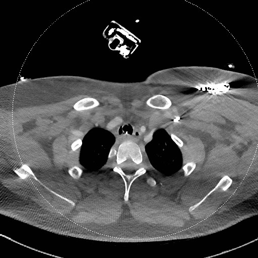 File:Neck CT angiogram (intraosseous vascular access) (Radiopaedia 55481-61945 B 91).jpg