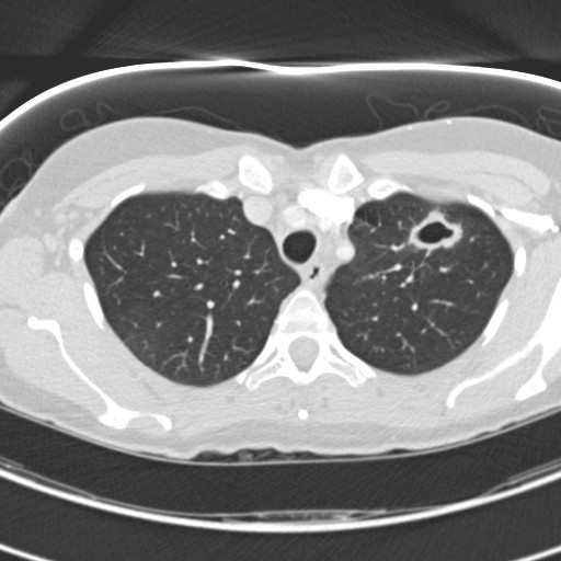 Necrobiotic pulmonary nodules - Crohn disease (Radiopaedia 20723-20631 Axial lung window 32).jpg