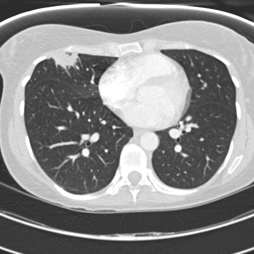 Necrobiotic pulmonary nodules - Crohn disease (Radiopaedia 20723-20631 Axial lung window 88).jpg