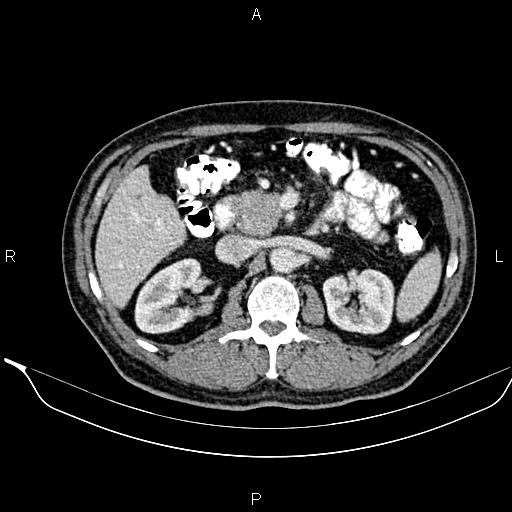Necrotizing pancreatitis (Radiopaedia 87796-104249 A 22).jpg