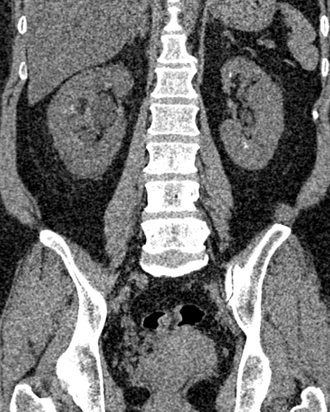 File:Nephrostomy for urosepsis (Radiopaedia 26180-26330 non-contrast 58).jpg