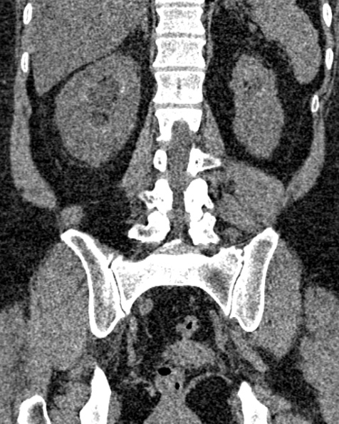 File:Nephrostomy for urosepsis (Radiopaedia 26180-26330 non-contrast 63).jpg