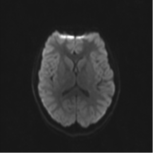 Neurenteric cyst (Radiopaedia 58641-65837 Axial DWI 55).png