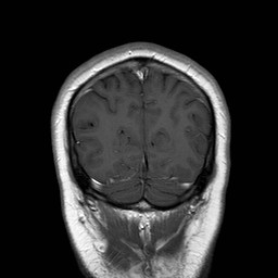 File:Neuro-Behcet's disease (Radiopaedia 21557-21505 Coronal T1 C+ 19).jpg