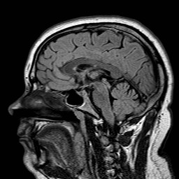File:Neuro-Behcet's disease (Radiopaedia 21557-21506 Sagittal FLAIR 17).jpg