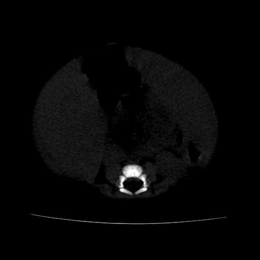 File:Neuroblastoma (Radiopaedia 20876-20799 Axial bone window 16).jpg