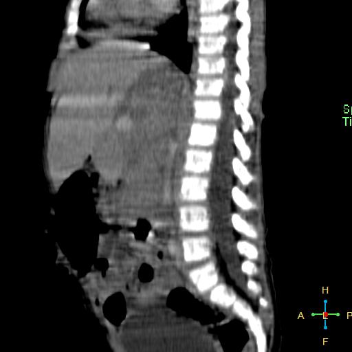 File:Neuroblastoma (Radiopaedia 24751-25016 C 15).jpg