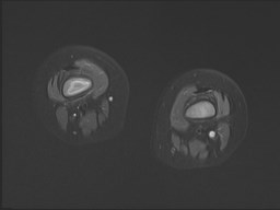 File:Neuroblastoma with bone metastases (Radiopaedia 67080-76414 Axial STIR 14).jpg