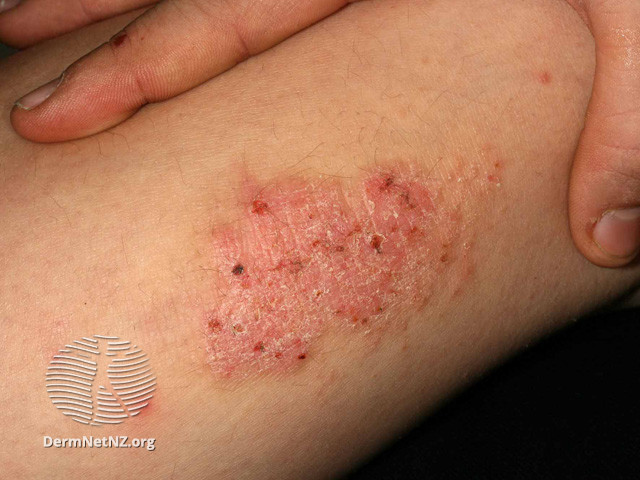 File:Neurodermatitis (DermNet NZ systemic-s-itchy-skin-55).jpg