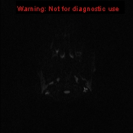 File:Neurofibromatosis type 1 with optic nerve glioma (Radiopaedia 16288-15965 Axial DWI 71).jpg
