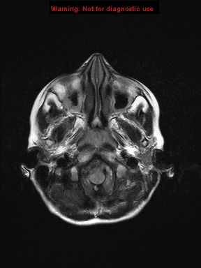 File:Neurofibromatosis type 1 with optic nerve glioma (Radiopaedia 16288-15965 Axial FLAIR 22).jpg