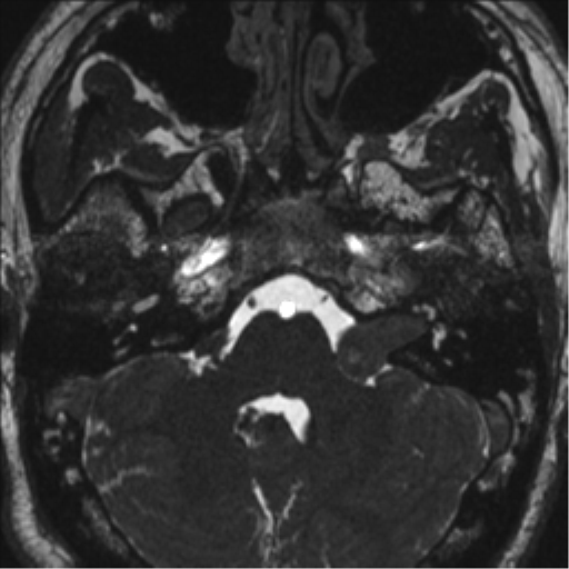Neurofibromatosis type 2 (Radiopaedia 44936-48838 E 24).png