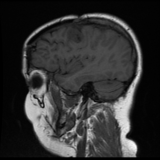File:Neurofibromatosis type 2 (Radiopaedia 45229-49247 Sagittal T1 16).png