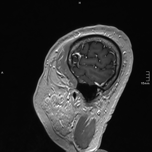 Neurosarcoidosis - involvement of the mesial temporal lobes (Radiopaedia 67429-76820 Sagittal T1 C+ 151).jpg