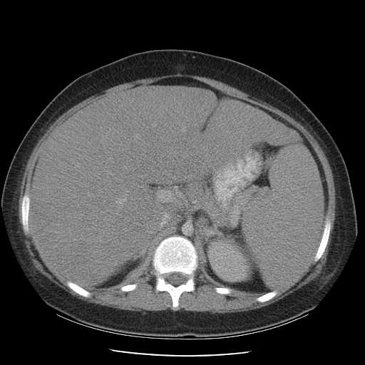 File:Non-Hodgkin lymphoma involving pelvis (Radiopaedia 21281-21197 A 23).jpg