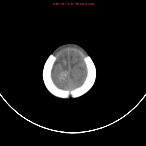 File:Non-accidental injury - bilateral subdural with acute blood (Radiopaedia 10236-10765 Axial non-contrast 21).jpg