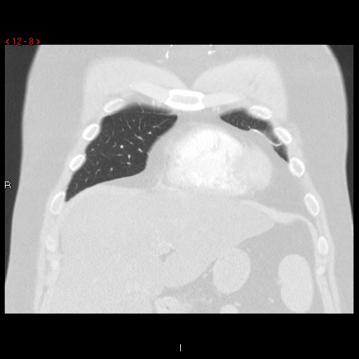 File:Non-specific interstitial pneumonitis (Radiopaedia 27044-27222 Coronal lung window 8).jpg
