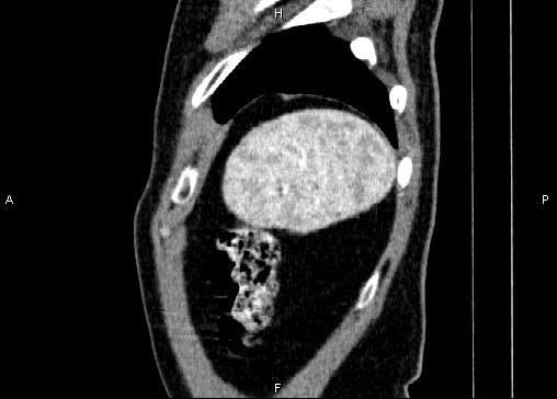 Non-syndromic pancreatic endocrine tumor (Radiopaedia 86958-103178 E 94).jpg
