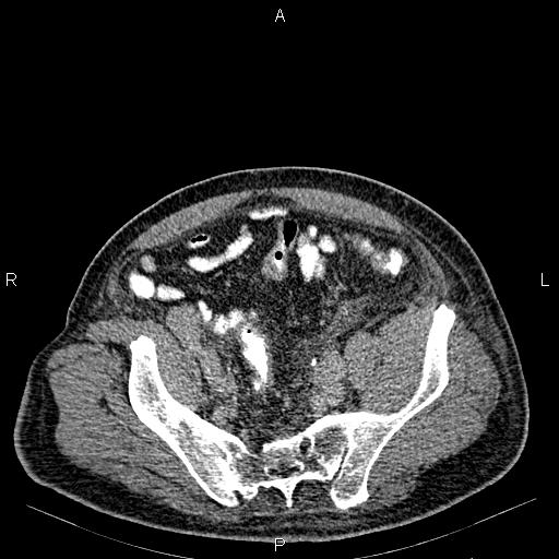Non Hodgkin lymphoma in a patient with ankylosing spondylitis (Radiopaedia 84323-99621 Axial C+ delayed 63).jpg