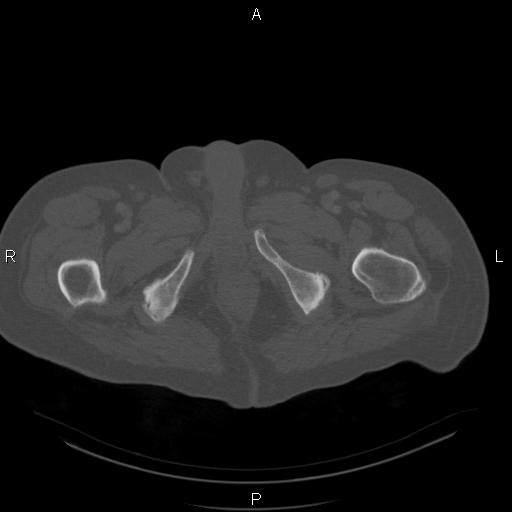 Non Hodgkin lymphoma in a patient with ankylosing spondylitis (Radiopaedia 84323-99624 Axial bone window 69).jpg