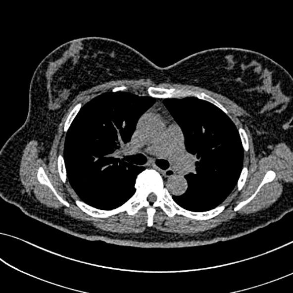 Normal CT chest- adult female (Radiopaedia 52522-58428 Axial non-contrast 54).jpg