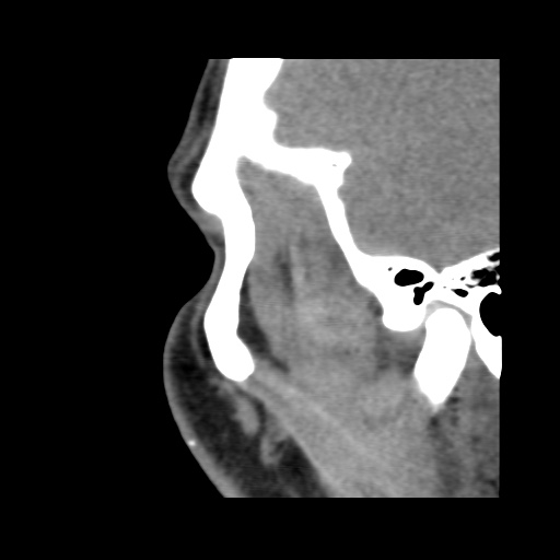 Normal CT paranasal sinuses (Radiopaedia 42286-45390 F 28).jpg