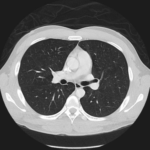 Normal CT pulmonary veins (pre RF ablation) (Radiopaedia 41748-44702 Axial lung window 16).png