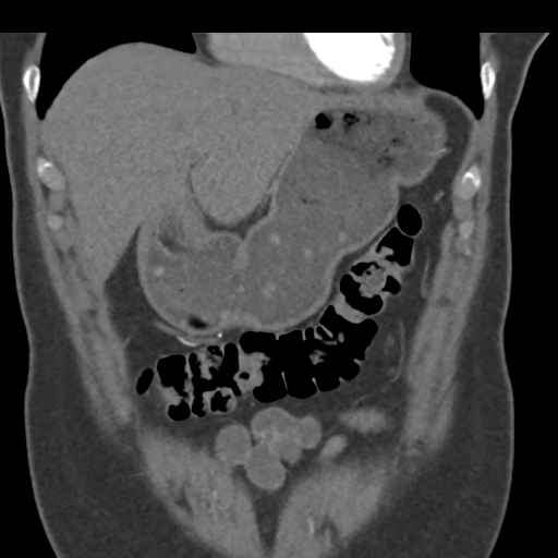 File:Normal CT renal artery angiogram (Radiopaedia 38727-40889 B 20).png